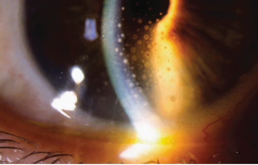 2.双眼前节检查显示羊脂状角膜后沉着物(kp),前房炎症细胞和闪辉