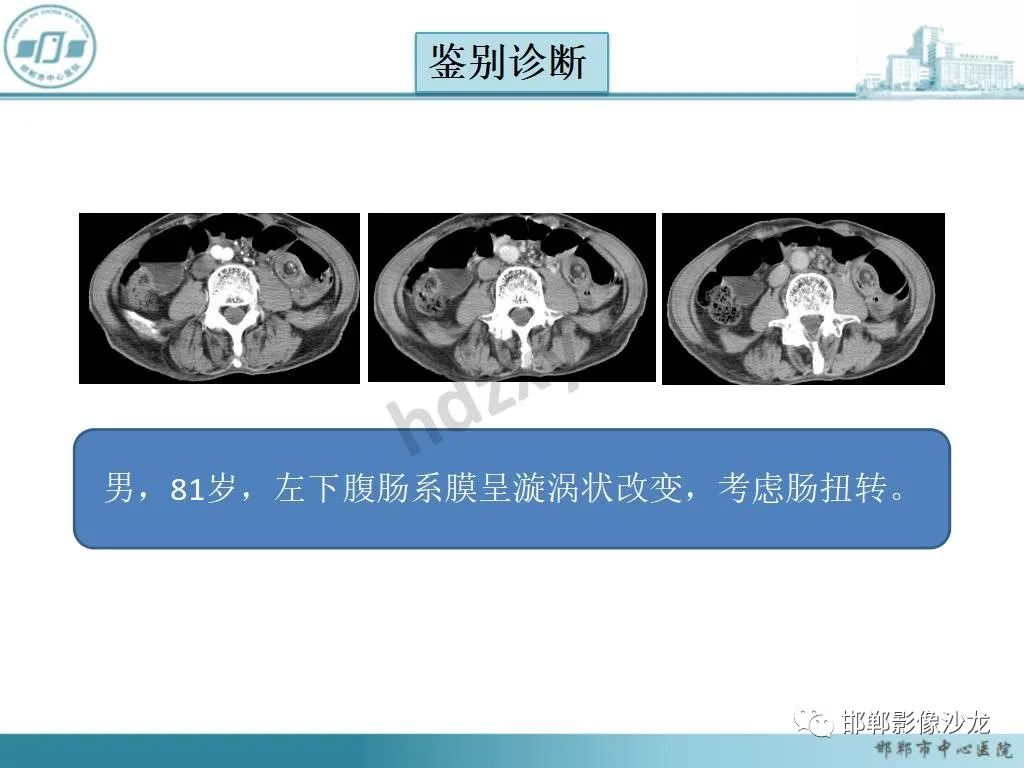 【急诊】腹部平片--肠扭转，大肠梗阻，中毒性巨结肠，腹膜后积气
