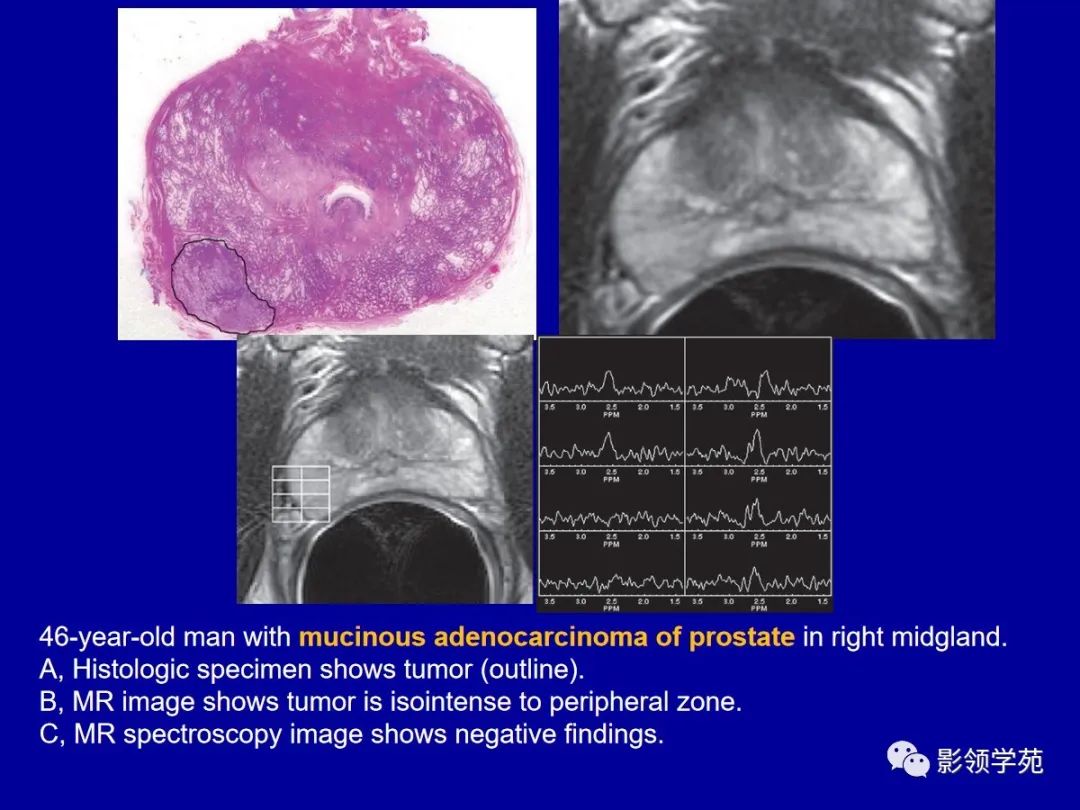 图3-28 精液中的前列腺细胞-基础医学-医学