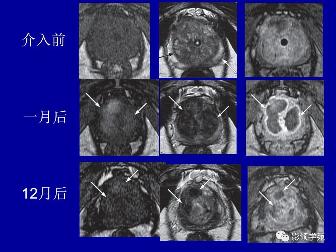 前列腺磁共振正常图像图片