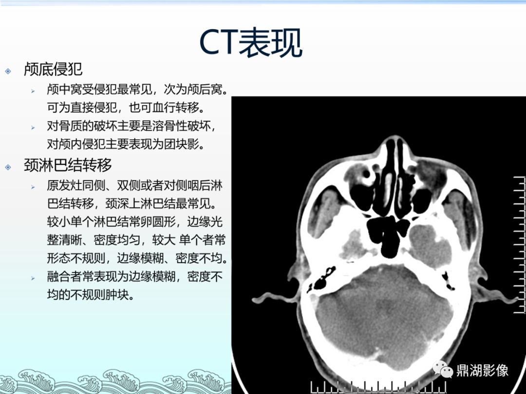 鼻咽部平扫ct解剖图图片