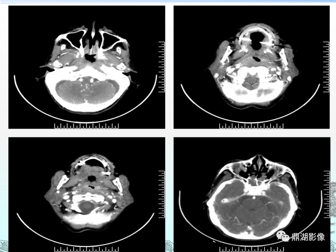鼻咽癌的ct诊断与鉴别诊断整理