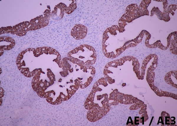 病理干货 | 卵巢交界性浆液性肿瘤诊断要点_医学界-助力医生临床决策
