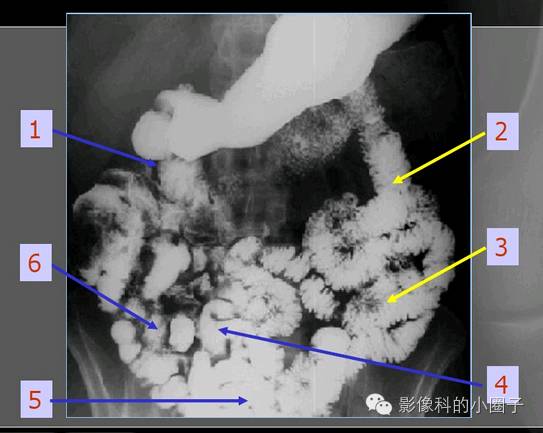 小肠x线分6组示意图图片