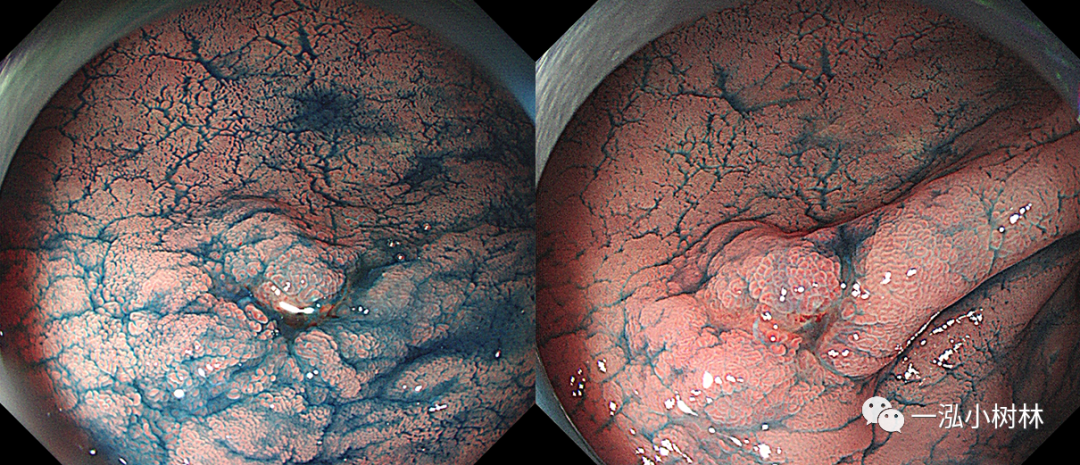 色素内镜注意事项_医学界-助力医生临床决策和职业成长