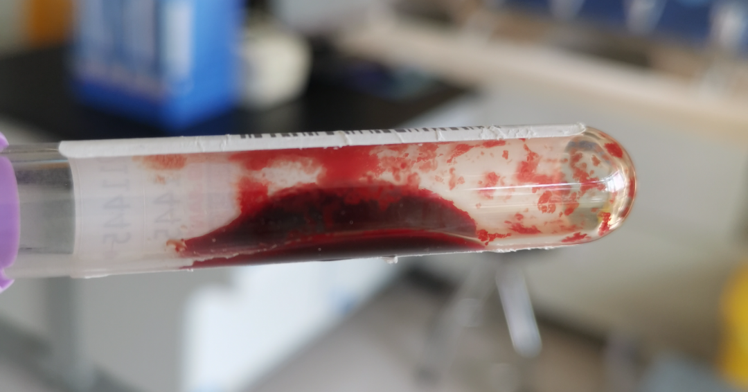 炎炎夏日,遇冷凝集素综合征一例_医学界-助力医生临床决策和职业成长