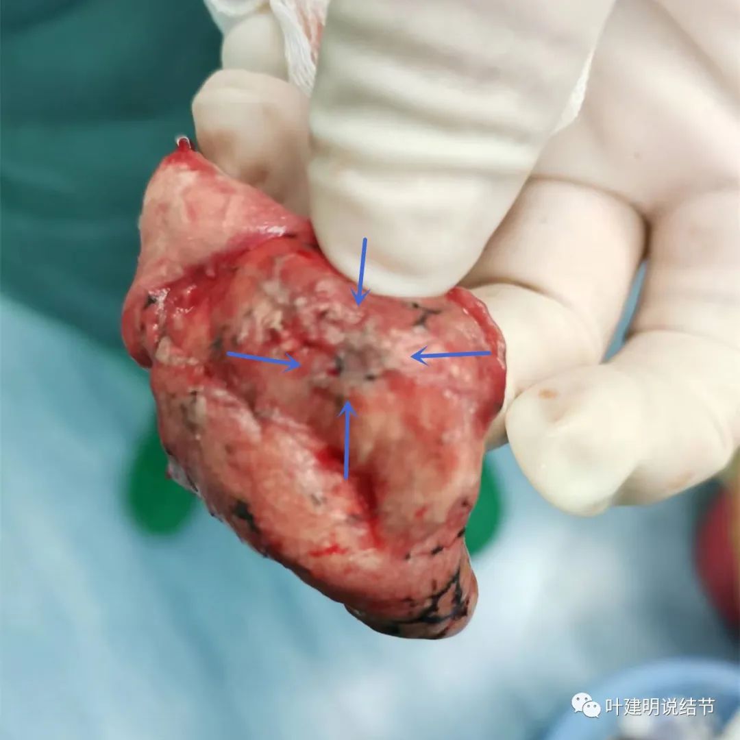 多次病例证明,有这样特征的肺磨玻璃结节是微浸润性腺癌_医学界-助力