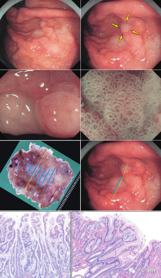 未感染幽門螺桿菌的早期胃癌/胃腫瘤的放大內鏡診斷_醫學界-助力醫生
