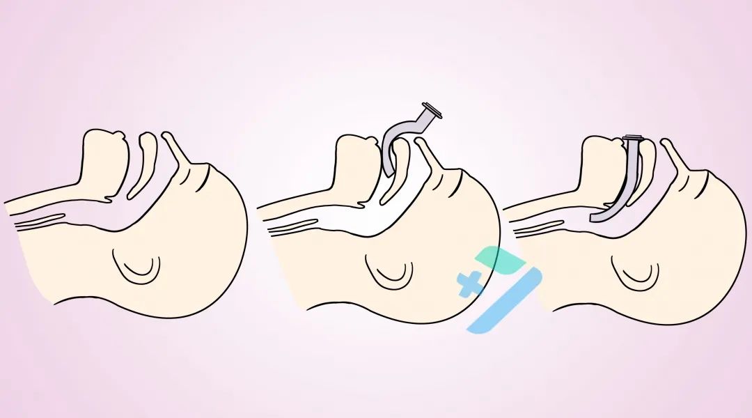 口咽通气道的正确使用_医学界-助力医生临床决策和职业成长