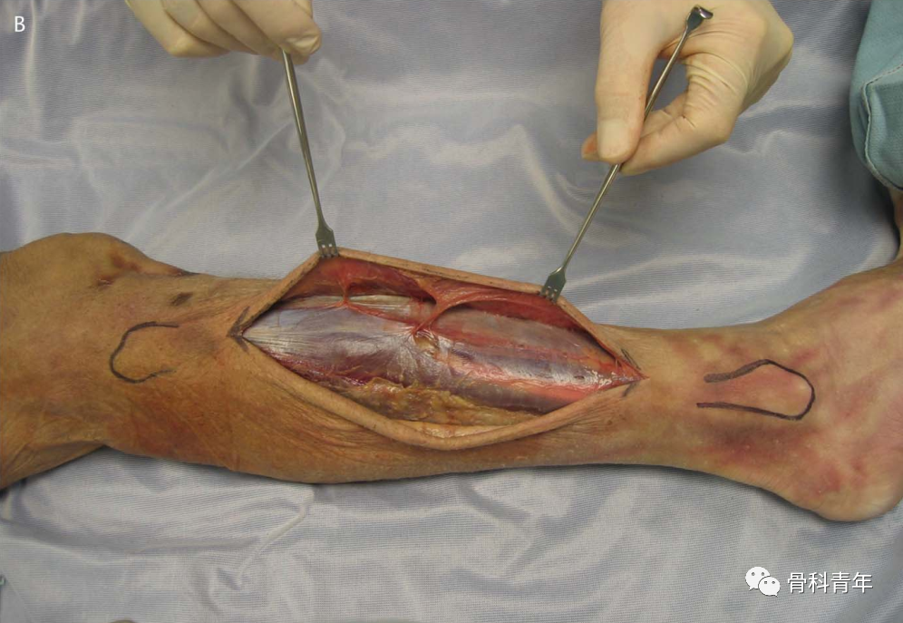 图解:小腿骨筋膜室综合征单切口减压技术_医学界-助力医生临床决策和