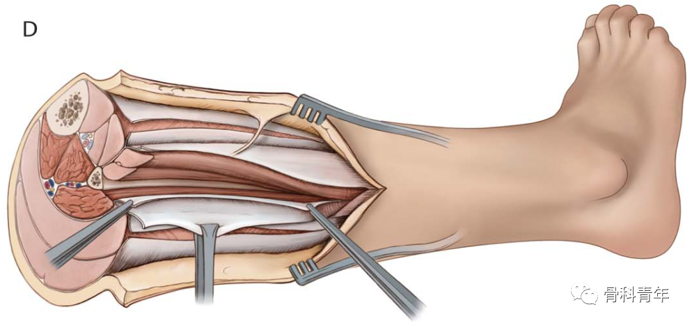 图解:小腿骨筋膜室综合征单切口减压技术_医学界-助力医生临床决策和