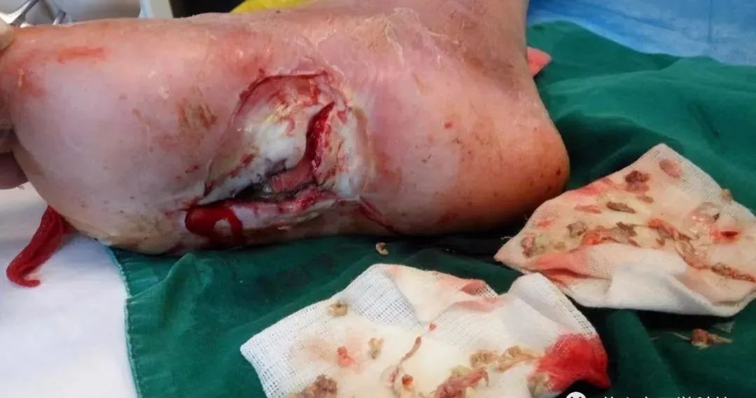 糖尿病足:有铁钉扎伤,有坏疽,最严重是双足缺血合并感染