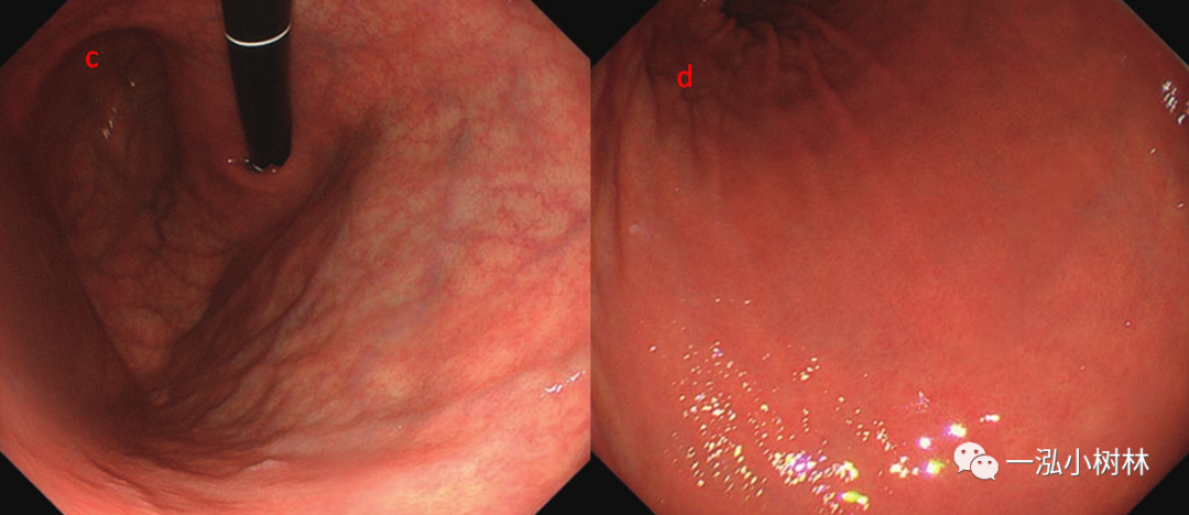 a:白光观察胃窦后壁约5 mm大褪色调平坦隆起性病变,未观察到萎缩性