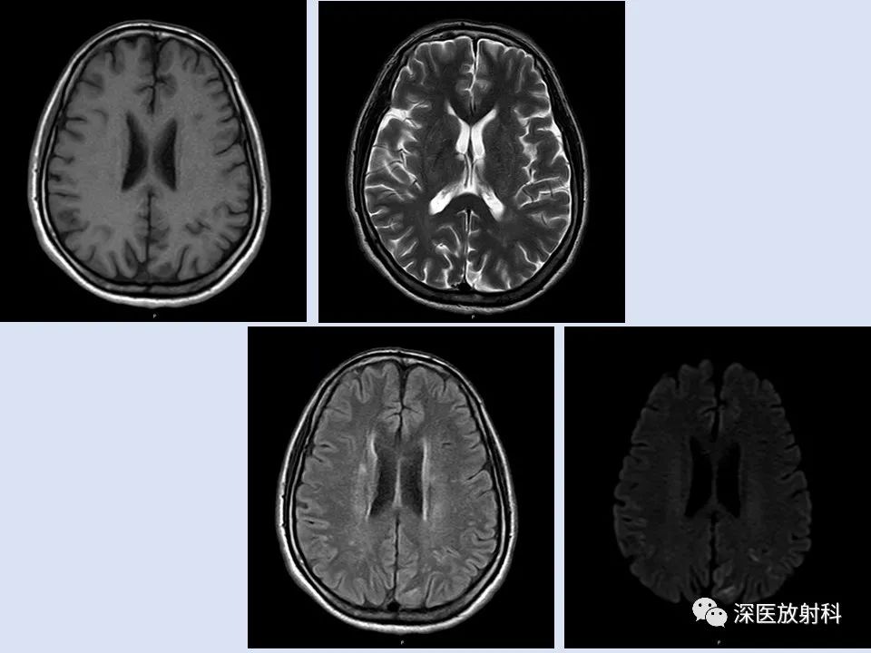 克雅氏病影像表现_医学界-助力医生临床决策和职业成长