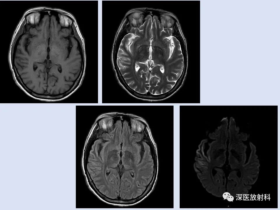 克雅氏病影像表现_医学界-助力医生临床决策和职业成长