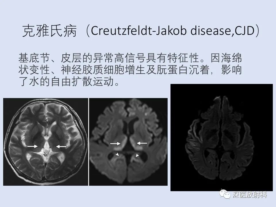 克雅氏病影像表现_医学界-助力医生临床决策和职业成长