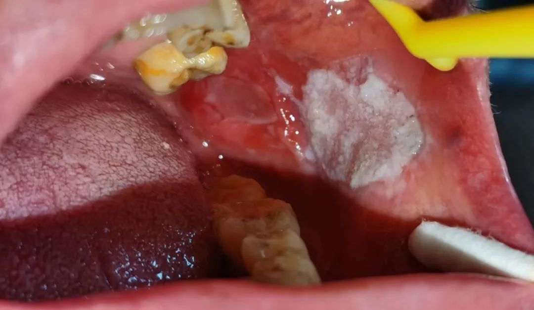 白斑病是92种常见的口腔粘膜疾病,可发生在口腔内任何部位,包括牙龈