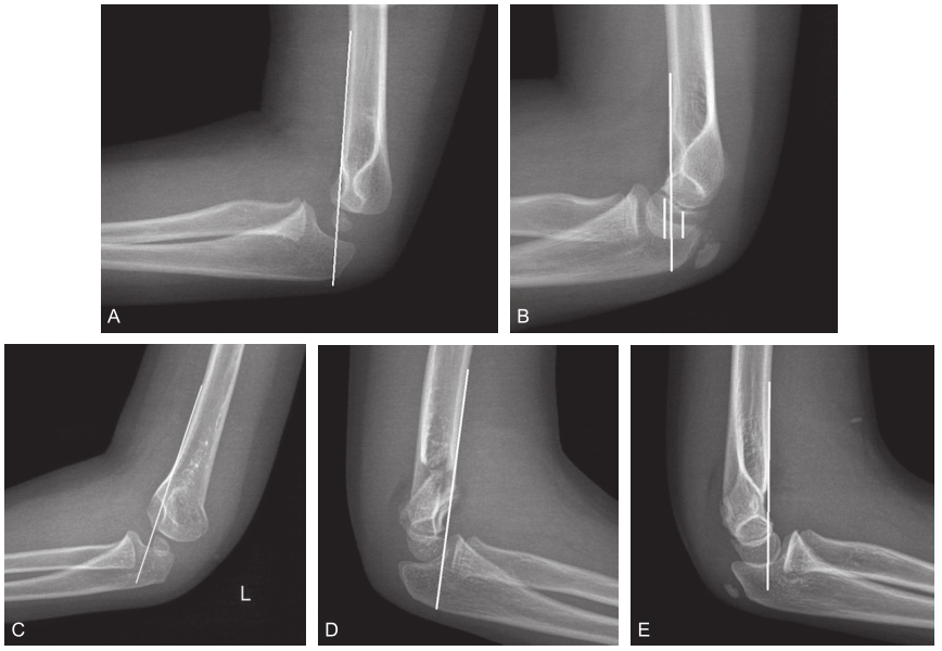 脂肪垫征,双弧征,肱骨前线,这三种肘部征象你了解吗?
