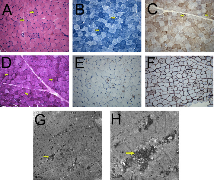庞贝病可累及多器官,danon病也可出现以上多系统表现,肌肉活检可提供