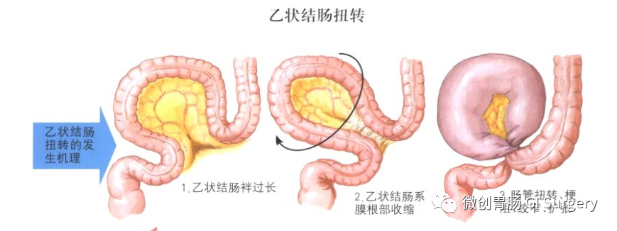 急腹症的外科处理系列之乙状结肠扭转