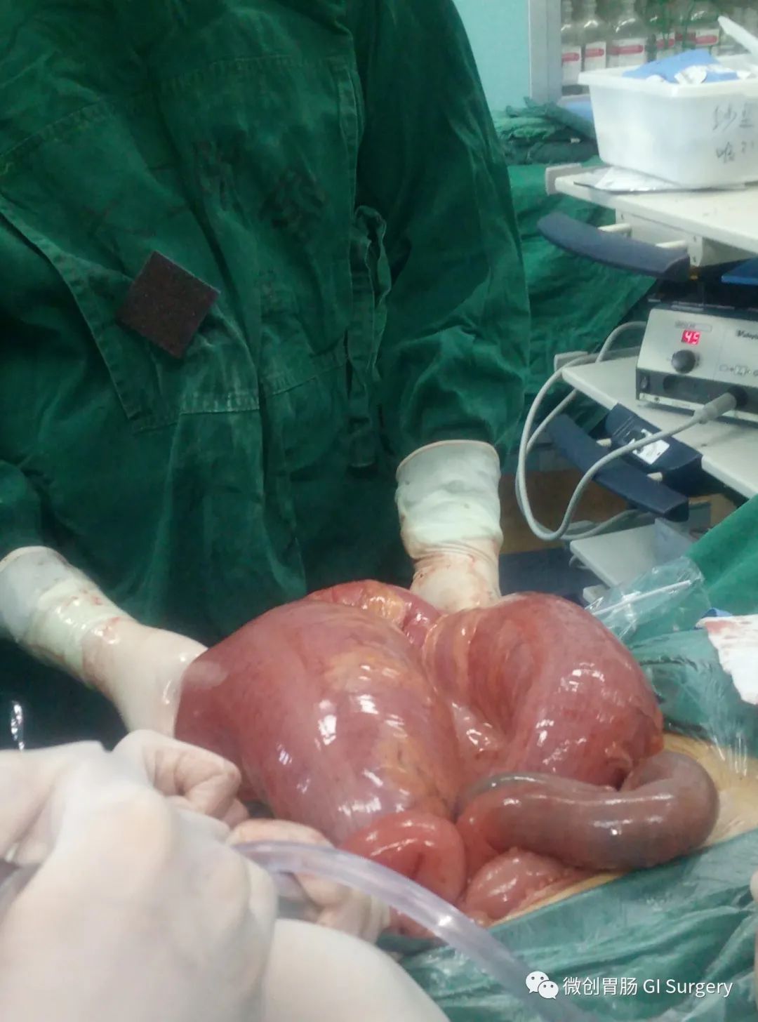 急腹症的外科处理系列之乙状结肠扭转