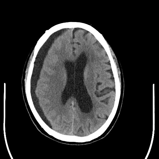 出院后2个月,患者出现头痛,左侧下肢无力,头部ct提示硬膜下积液01