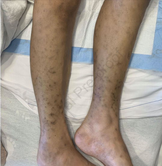 多发皮下结节伴色素沉着 会是什么病 看图诊断 医学界 助力医生临床决策和职业成长