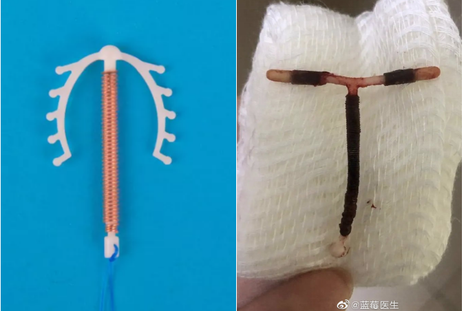 又见节育环穿透子宫刺入膀胱有这些症状没绝经也要去取环