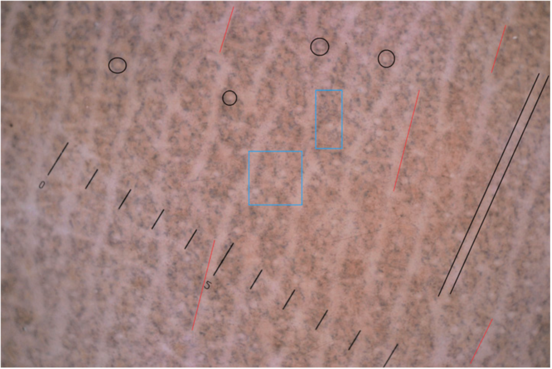 常伴有剧烈瘙痒,皮肤镜有助于辨认细小的wickham纹和其他特征性表现