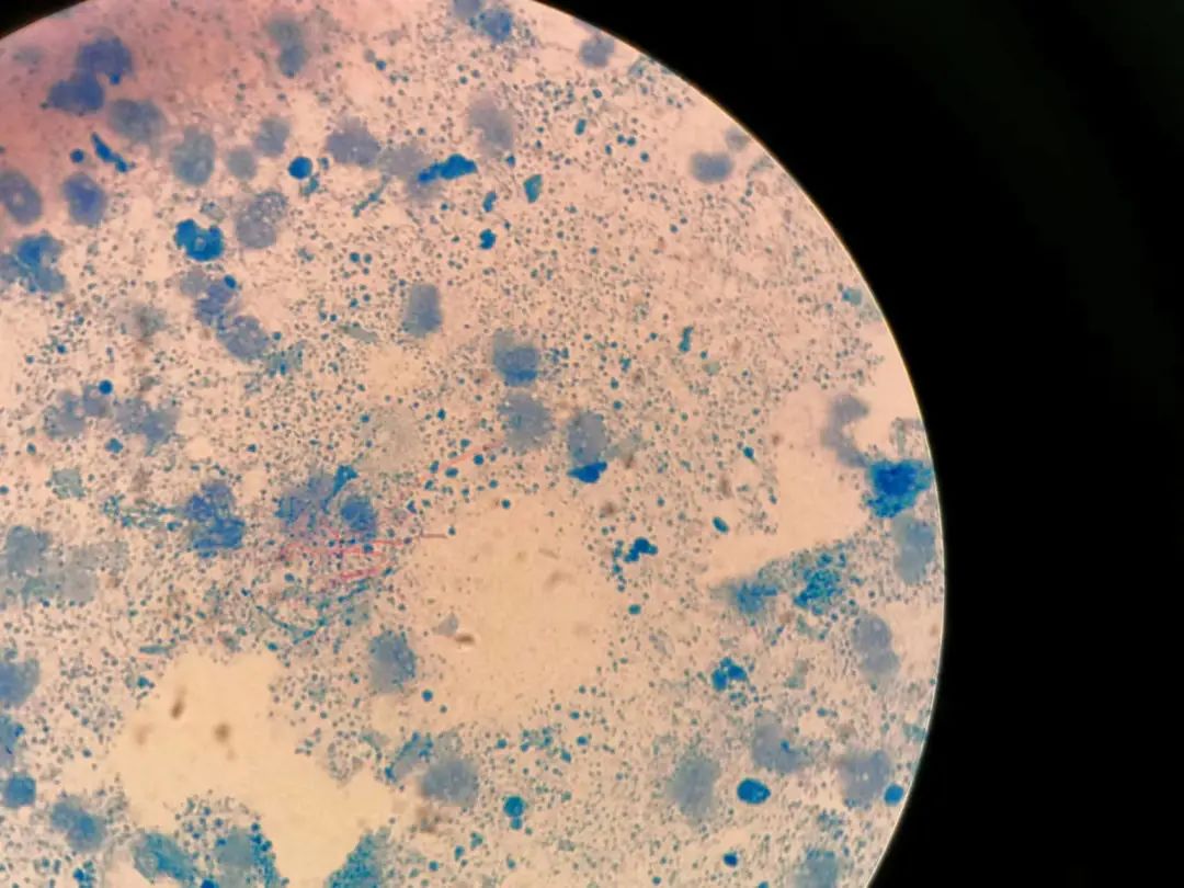 苏新格兰诺卡菌引起的全身多处脓肿