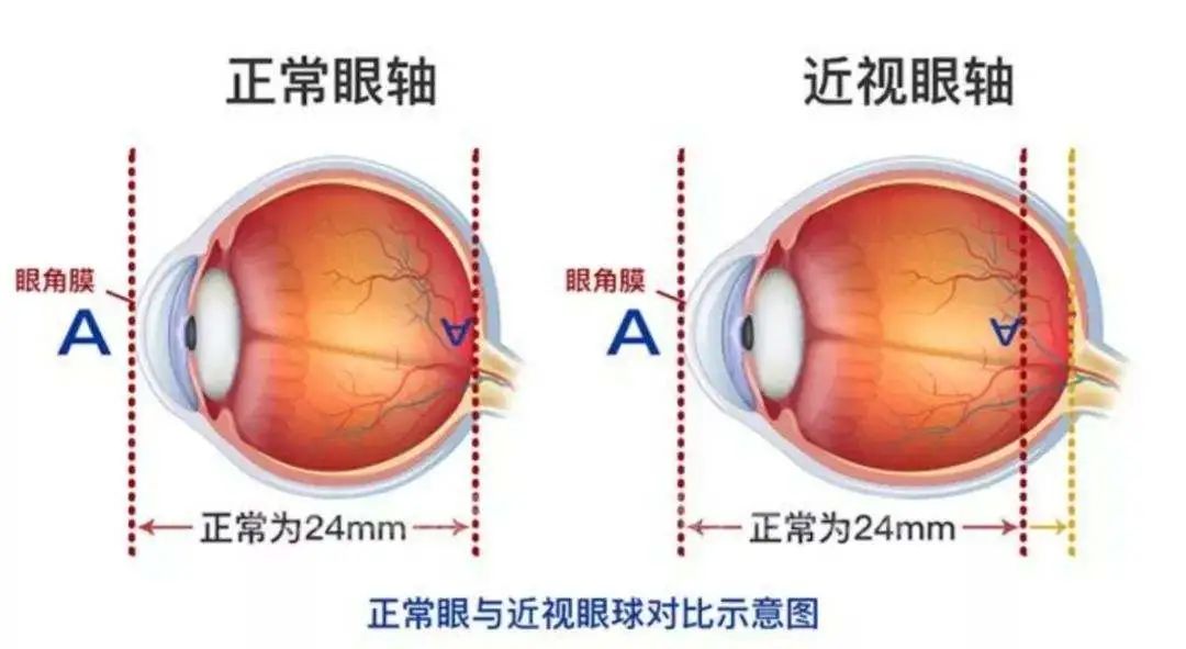 0 01 阿托品滴眼液延缓近视增长 医学界 助力医生临床决策和职业成长