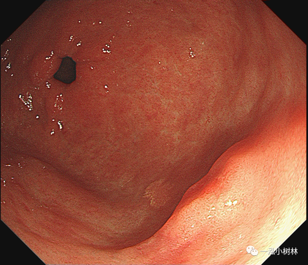 胃窦黄斑瘤图片