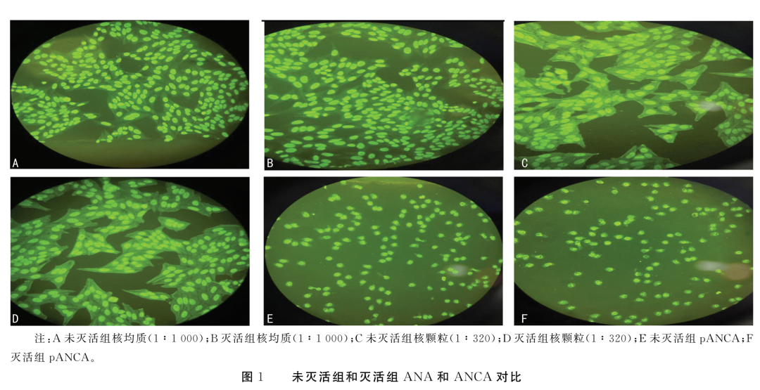 77例ana阴性标本和77例anca阴性标本,灭活组和未灭活组均呈阴性结果