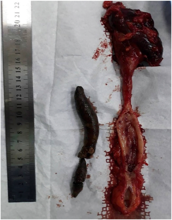 最大的输尿管结石 (伊拉克)