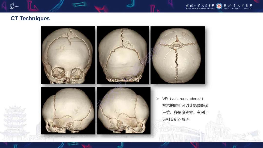 儿童颅骨骨折图片