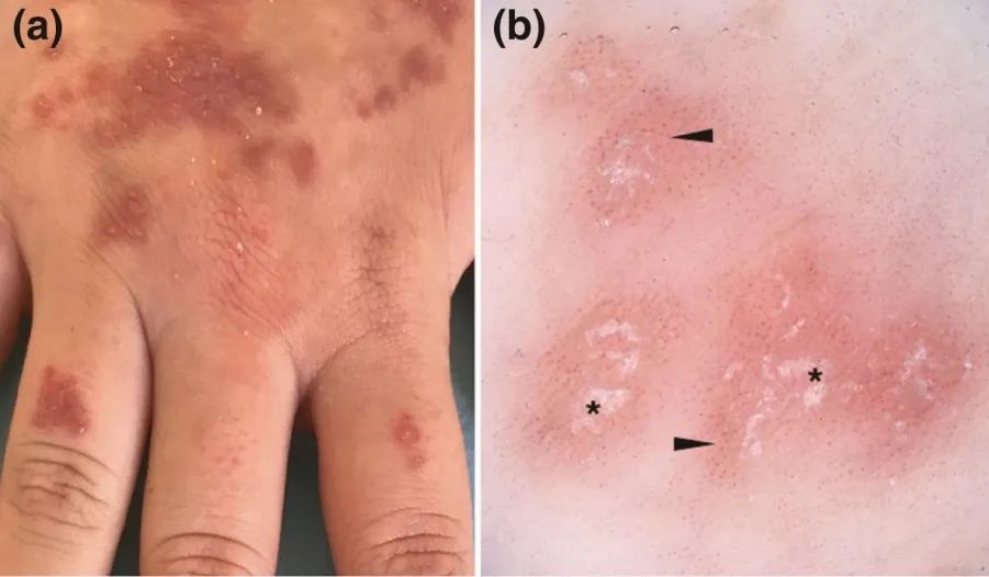 白色片状鳞屑(黄圈),白色无结构区(黑色星号)及wickham纹(蓝色星号)