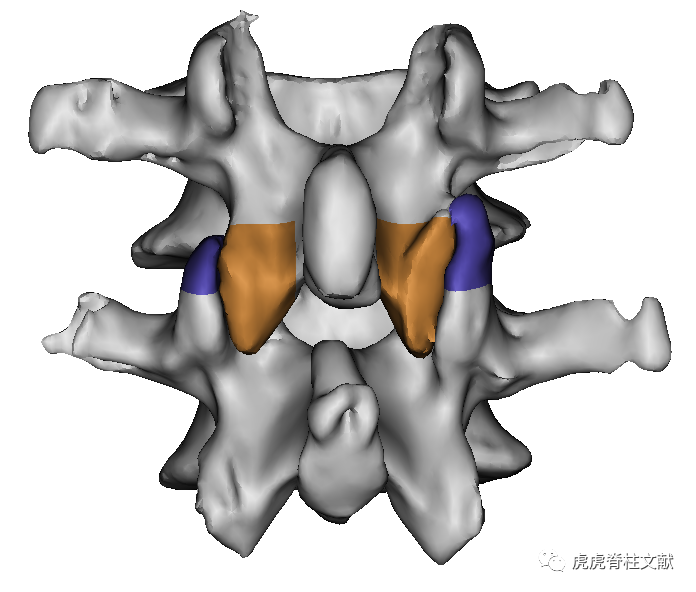 脊柱6级截骨三维图谱(mimics 21.