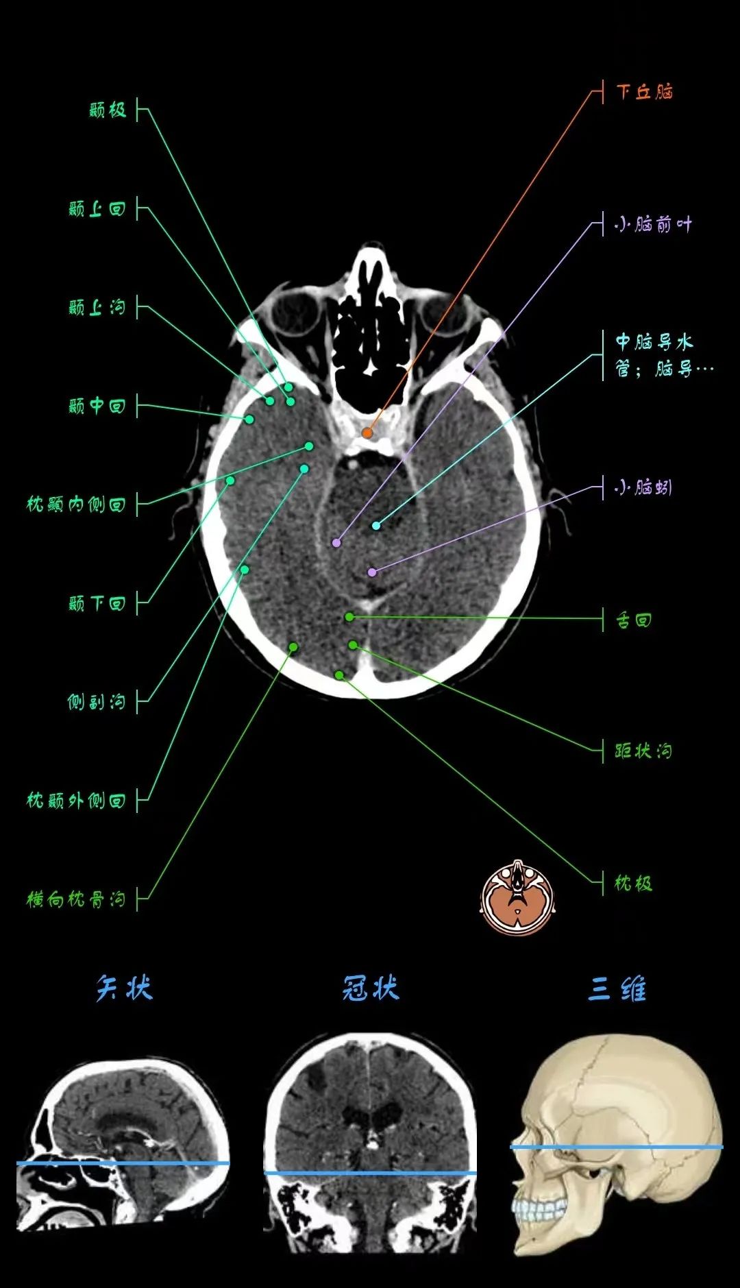 颅内血管CT解剖图图片