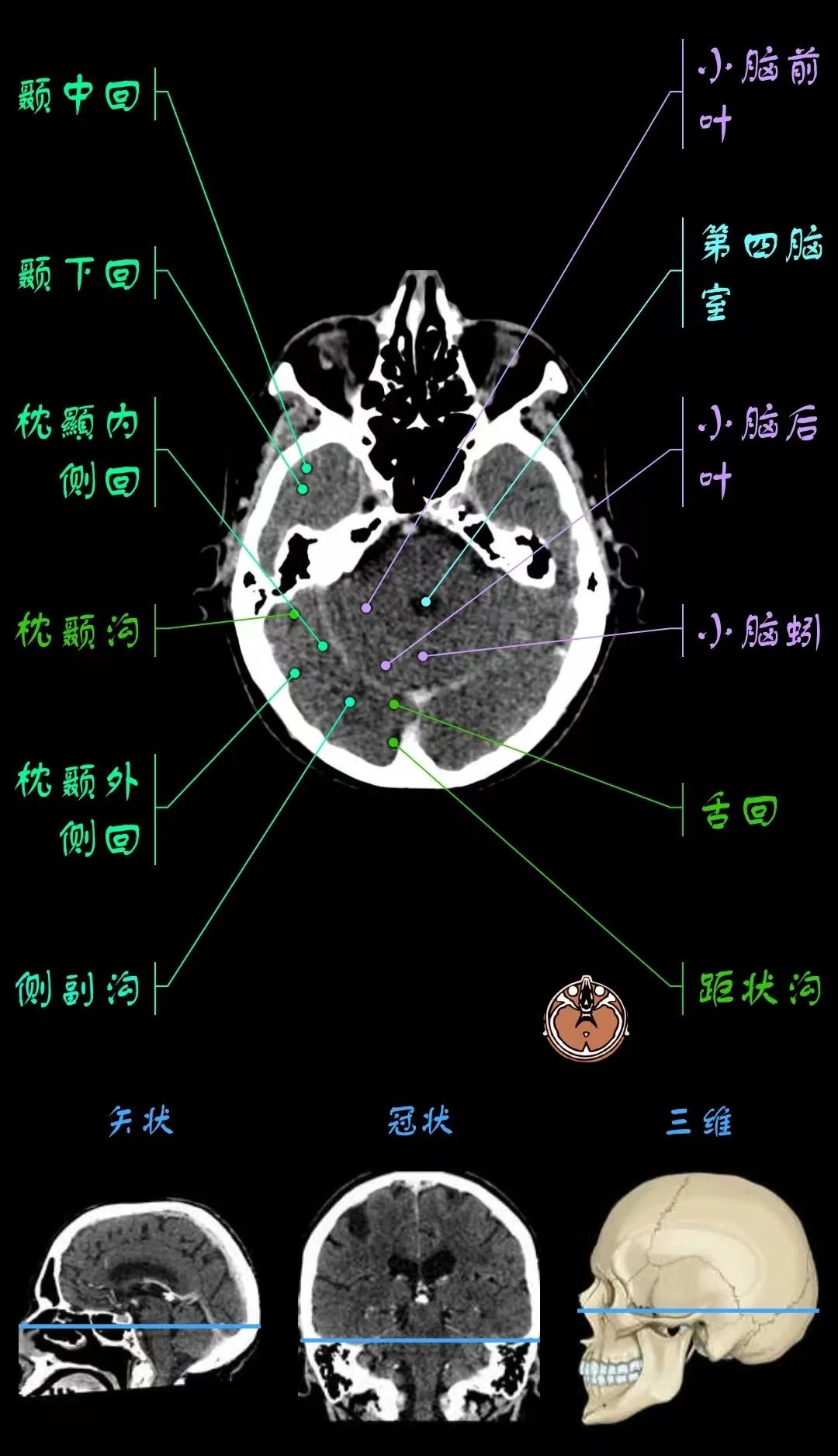 小脑蚓部影像解剖图片