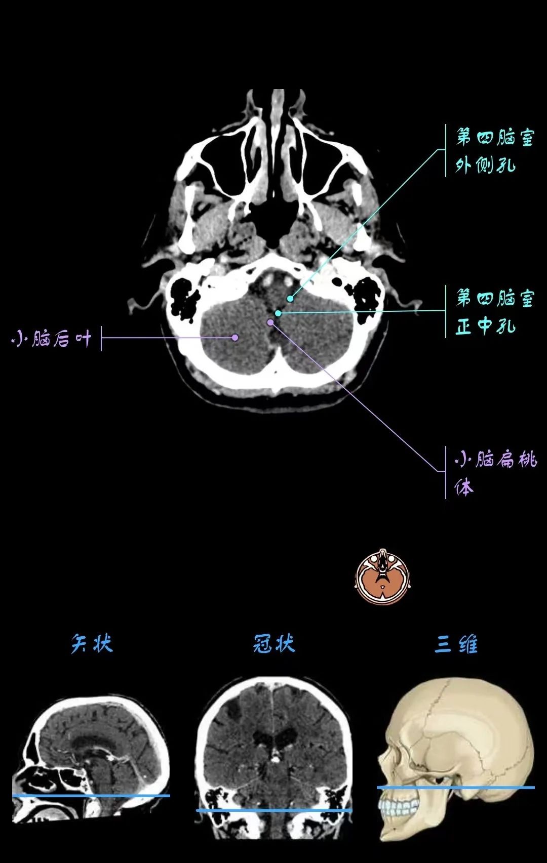 颅内血管CT解剖图图片