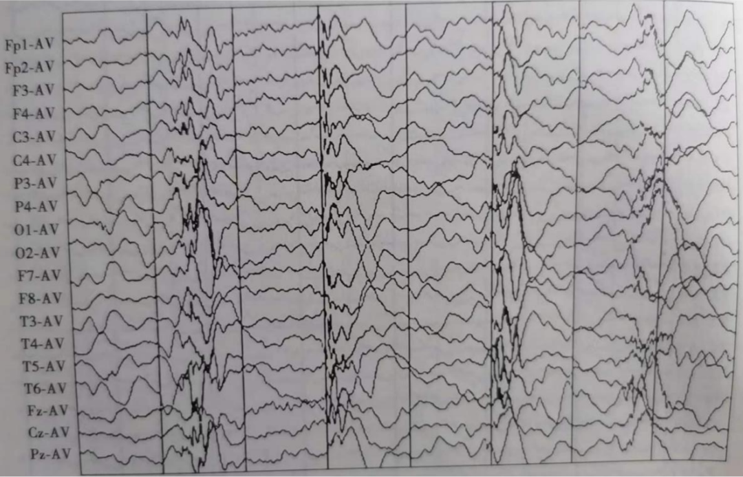 正常及异常脑电图的判读,入门攻略来了