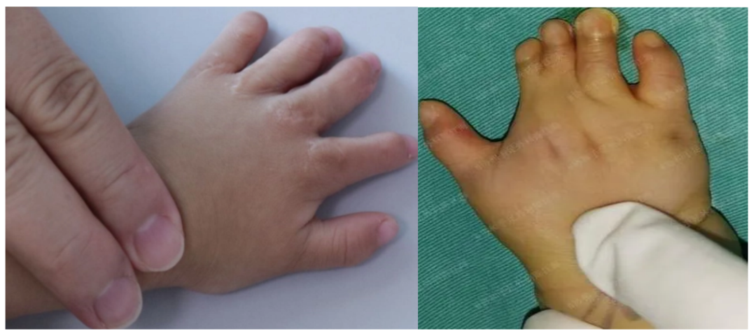 儿科医生教你通过观察孩子的手指,判断孩子是否健康