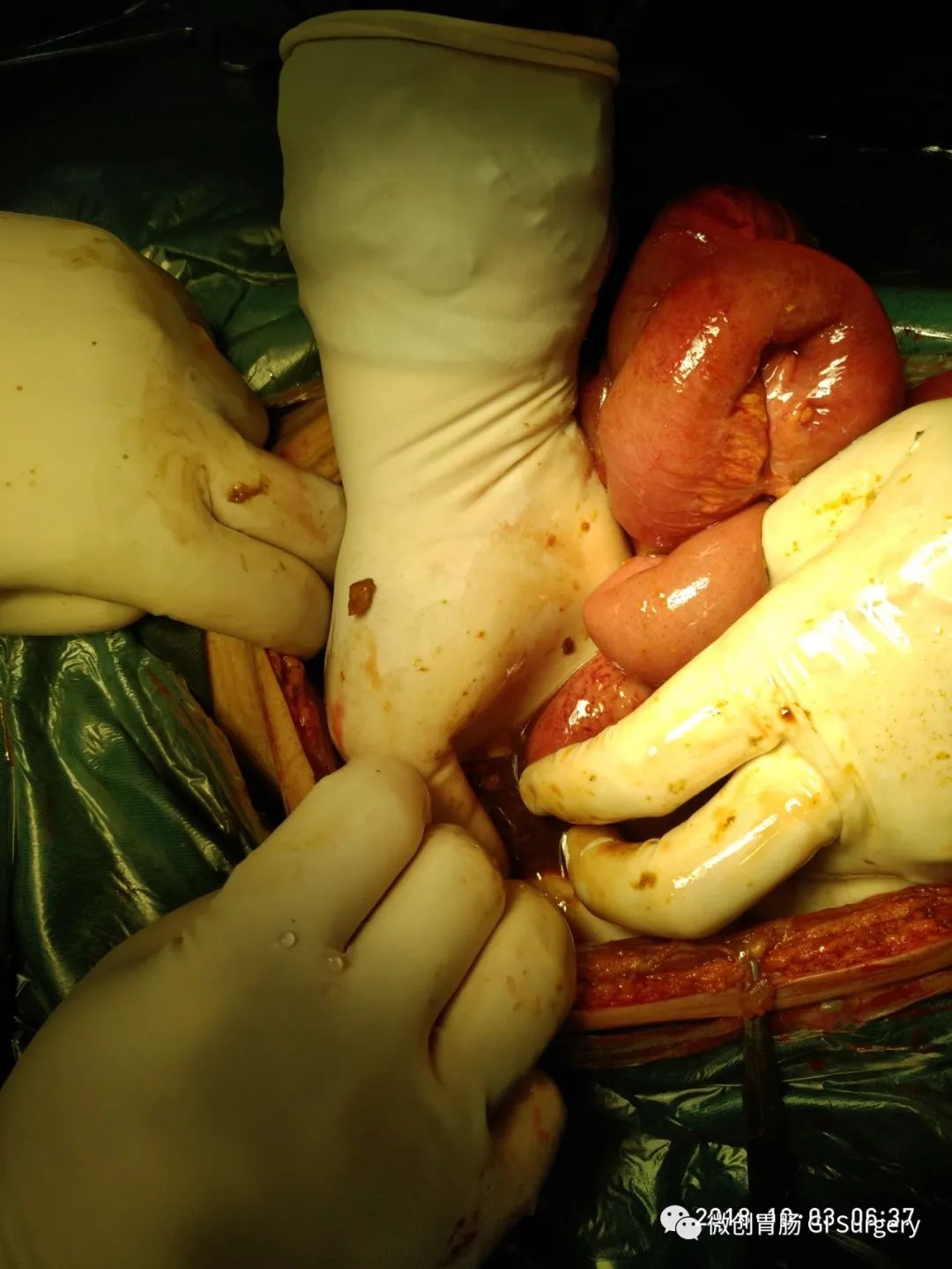 外科急腹症系列之小肠穿孔(粘连性肠梗阻)