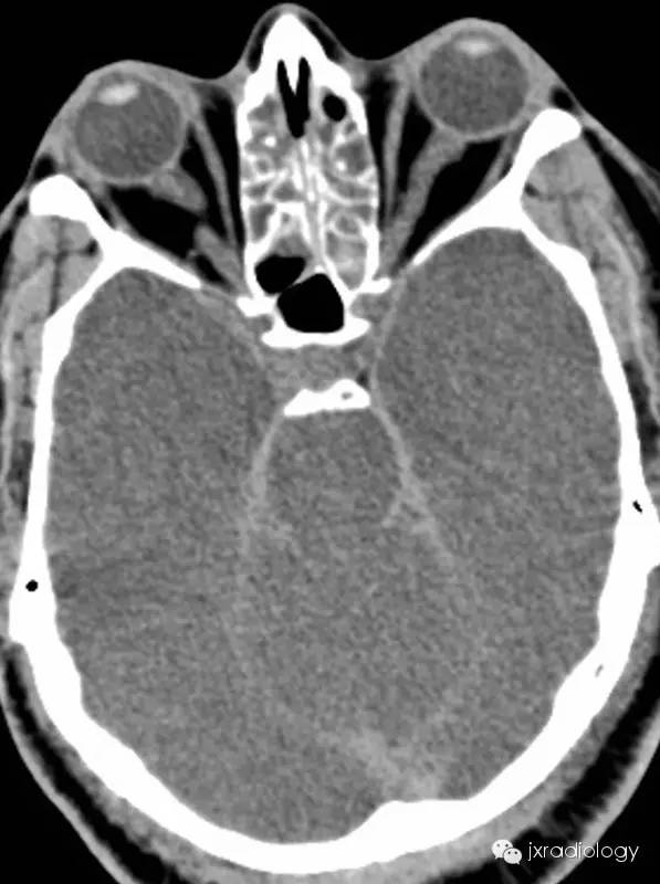 density, loss of gray-white matter differentiation, effacement