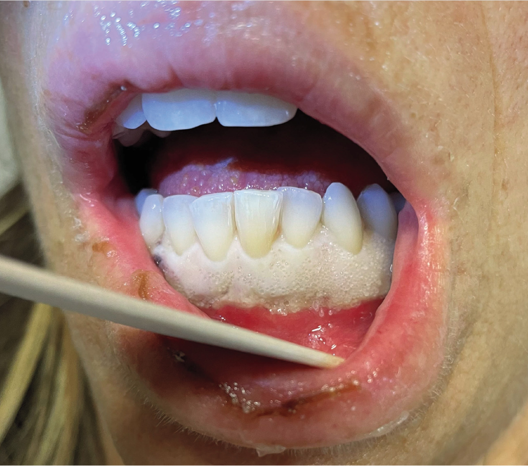 牙龈萎缩的症状表现 - 知乎