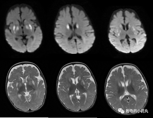 一文读懂:leigh综合征_医学界-助力医生临床决策和职业成长