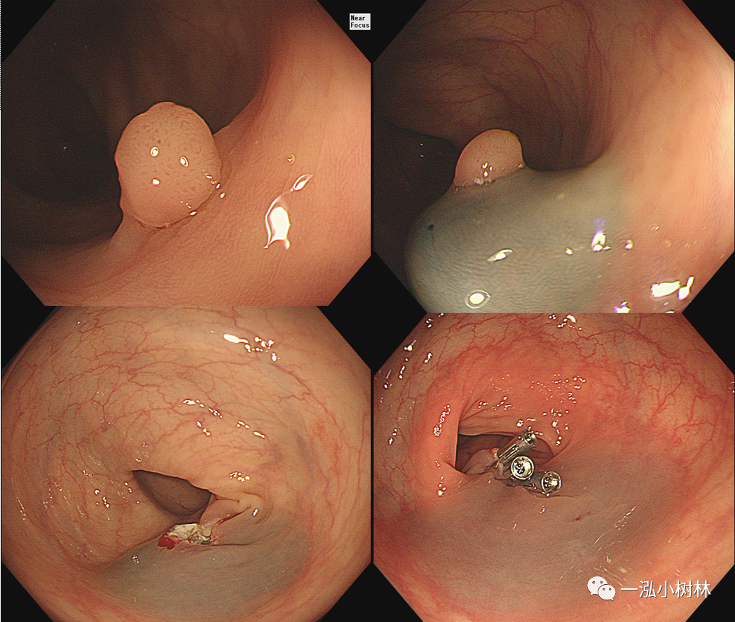 肠息肉切除过程图图片