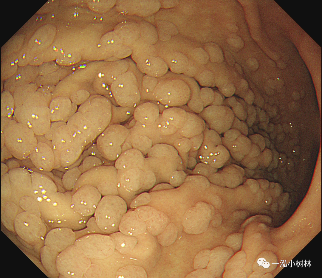 胃息肉的种类图片大全图片