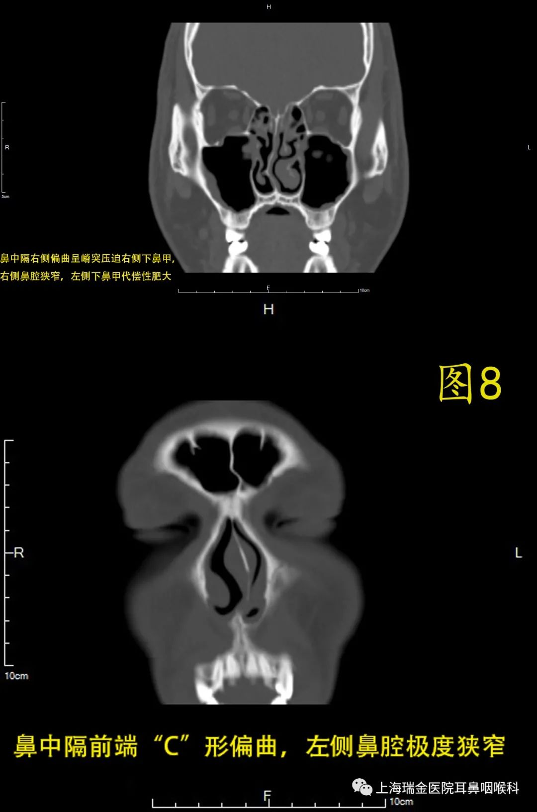 图3—69 气化中鼻甲和偏曲的鼻中隔-眼耳鼻喉-医学