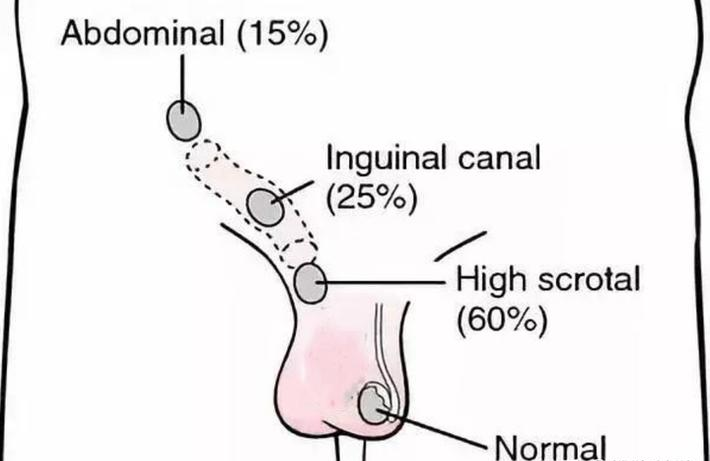 腹腔内下降阶段在胚胎10～15周完成,睾丸下降至内环口处,受amh调控